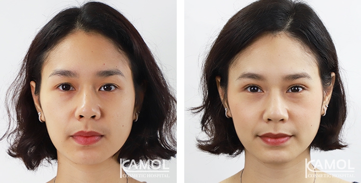 Blepharoplasty / Eyelid Surgery 66 lg 6494958ee4d64 image
