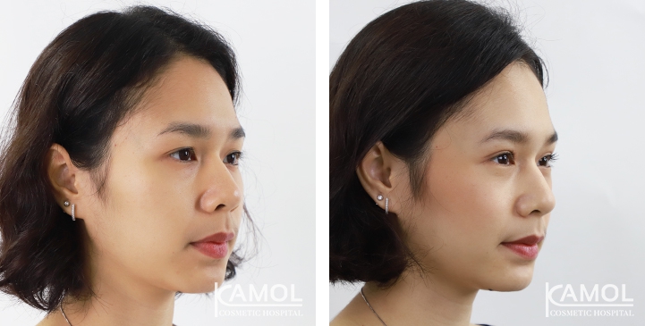 Blepharoplasty / Eyelid Surgery 68 lg 6494958ee6d3c image