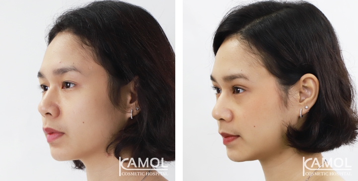 Blepharoplasty / Eyelid Surgery 67 lg 6494958ee8d4f image