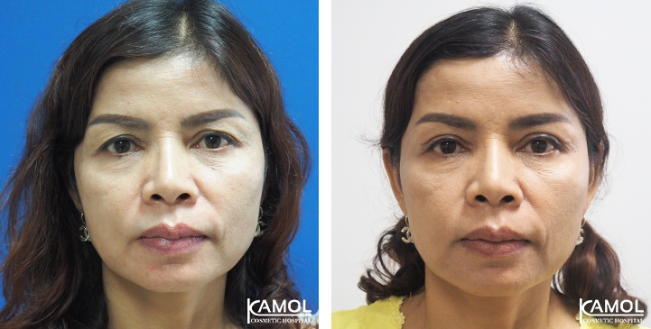 Blepharoplasty / Eyelid Surgery 70 lg 6494958eeb60d image