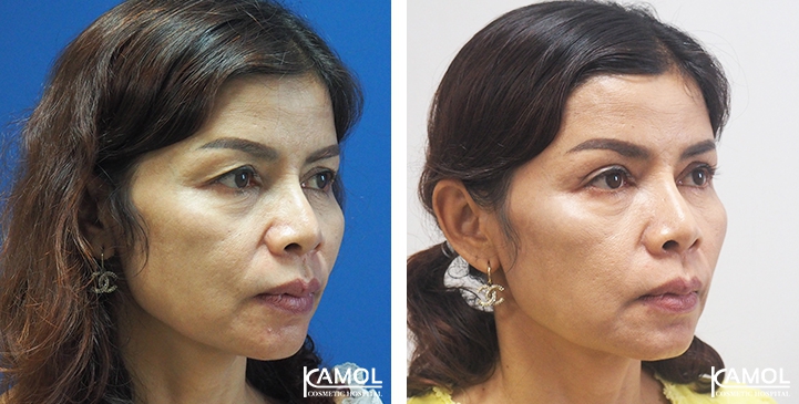 Blepharoplasty / Eyelid Surgery 72 lg 6494958eed578 image
