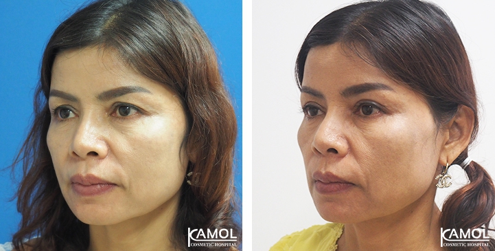 Blepharoplasty / Eyelid Surgery 71 lg 6494958eef5d0 image