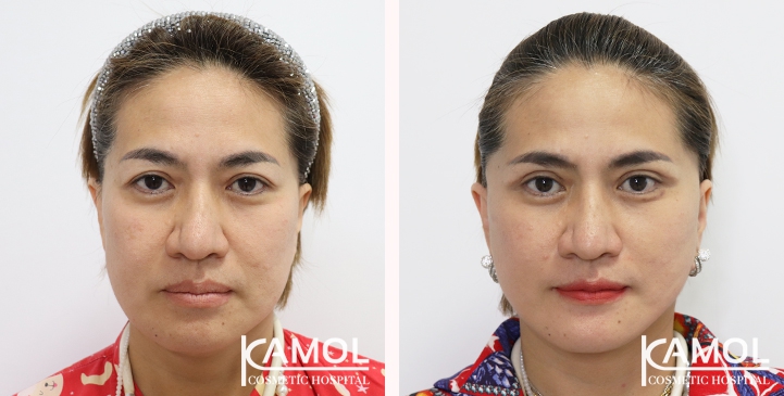 Face Lift 14 lg 6494958f466af image