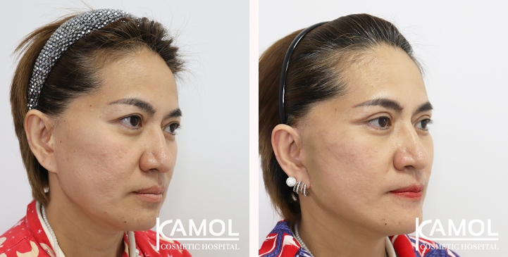 Face Lift 15 lg 6494958f48871 image