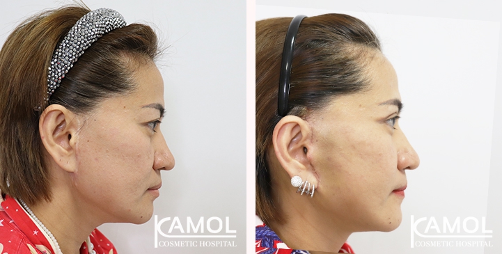 Face Lift 18 lg 6494958f4ac99 image