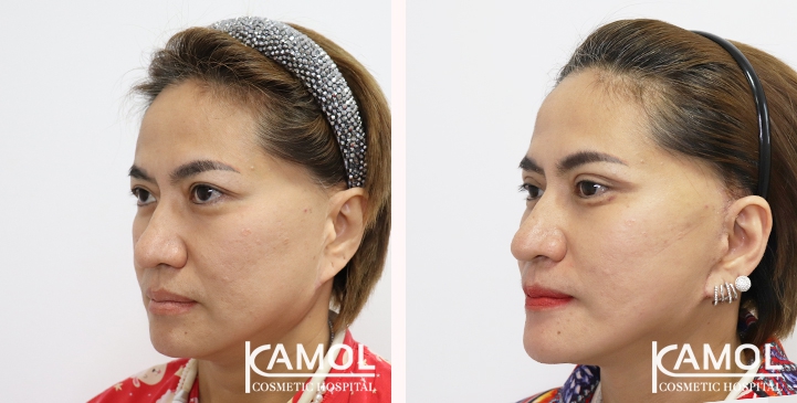 Face Lift 17 lg 6494958f4cb31 image