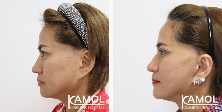 Face Lift 16 lg 6494958f4eaf9 image