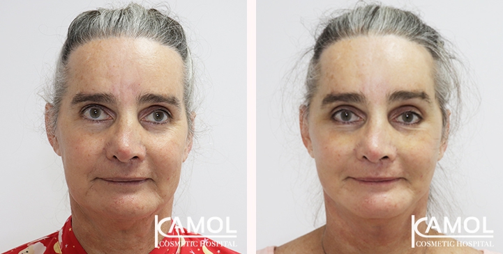 Face Lift 20 lg 6494958f51937 image