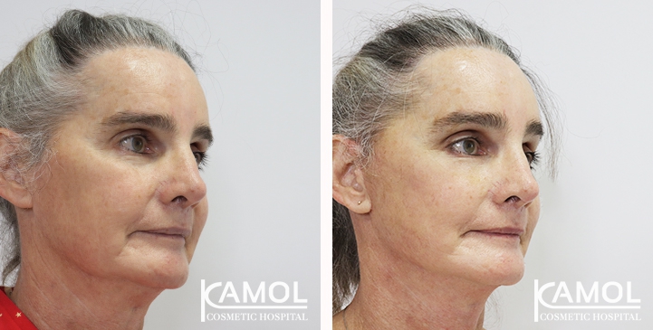 Face Lift 23 lg 6494958f53fd2 image