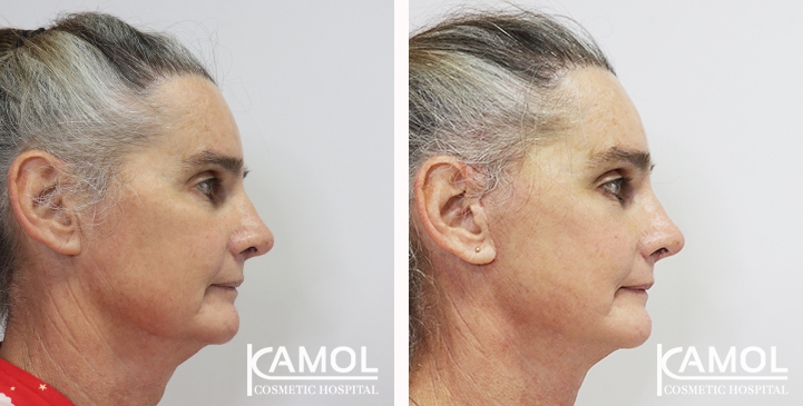 Face Lift 22 lg 6494958f56259 image