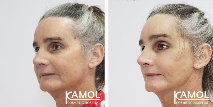 Face Lift 21 lg 6494958f58720 image