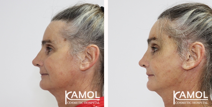 Face Lift 24 lg 6494958f5a895 image
