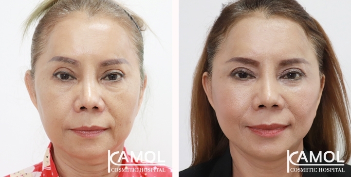 Face Lift 26 lg 6494958f5d3e5 image