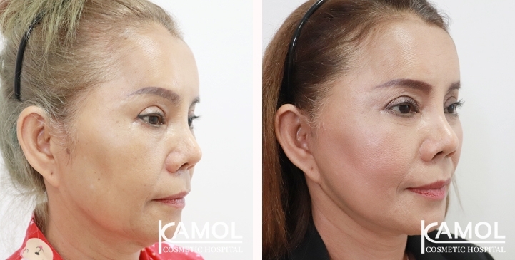 Face Lift 30 lg 6494958f5f2a0 image