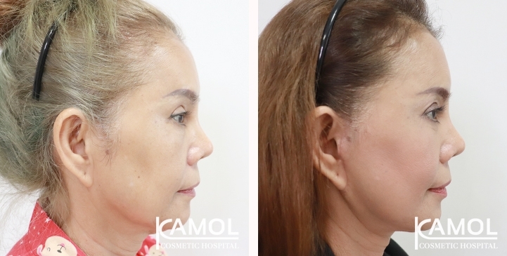 Face Lift 28 lg 6494958f6117a image