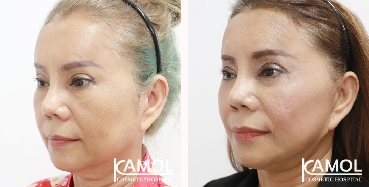Face Lift 27 lg 6494958f63154 image