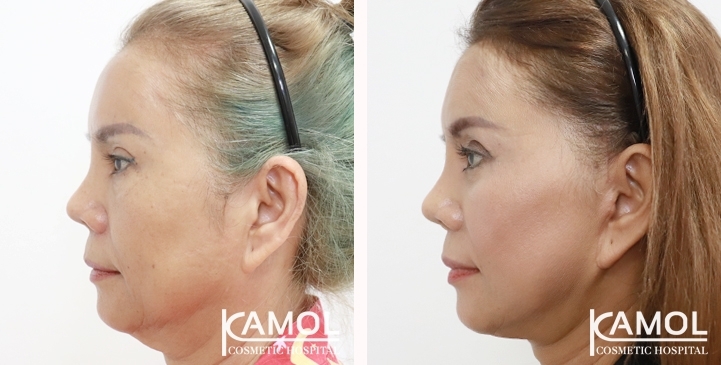 Face Lift 29 lg 6494958f656c8 image