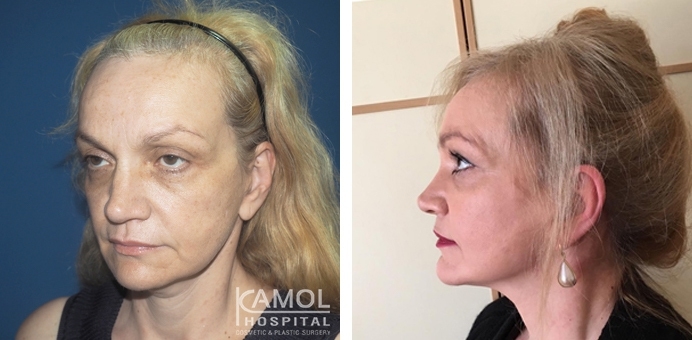 Face Lift 34 lg 6494958f69f79 image