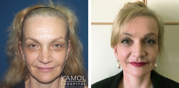 Face Lift 32 lg 6494958f6be4b image