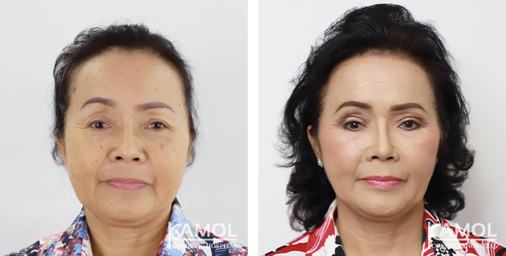Face Lift 36 lg 6494958f71374 image