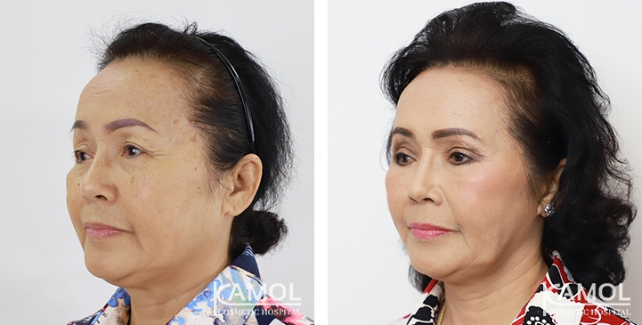 Face Lift 40 lg 6494958f736e8 image