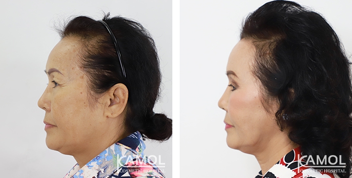Face Lift 37 lg 6494958f7562f image
