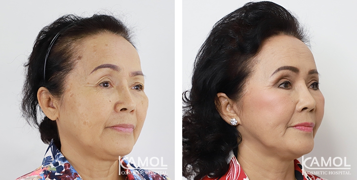 Face Lift 39 lg 6494958f776dd image