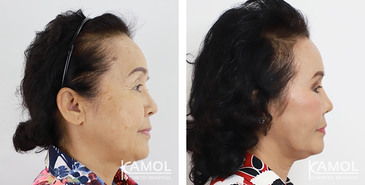 Face Lift 38 lg 6494958f794b0 image