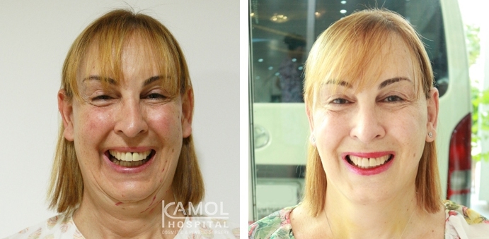 Face Lift 42 lg 6494958f7be6b image