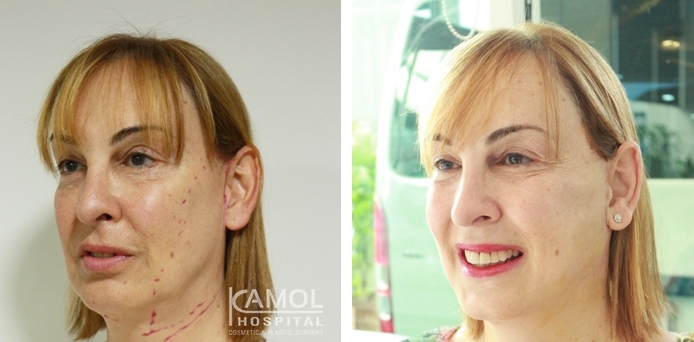 Face Lift 44 lg 6494958f7e086 image