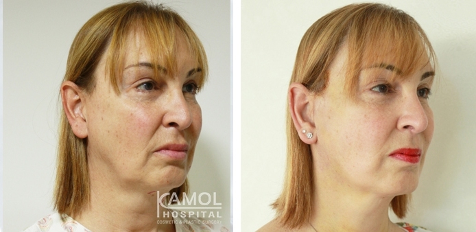 Face Lift 43 lg 6494958f7fee4 image