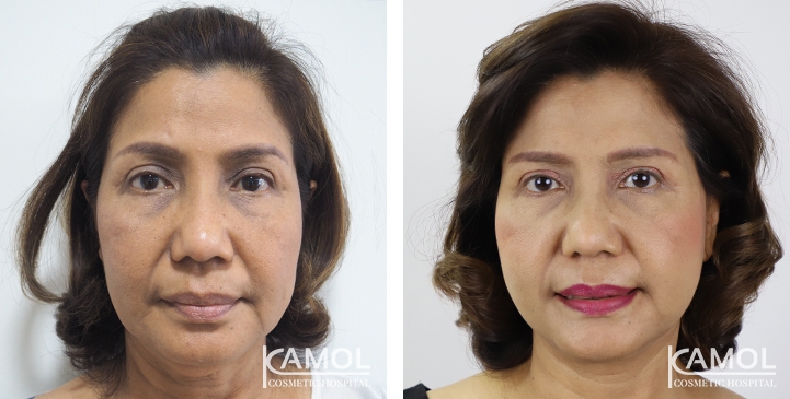 Face Lift 46 lg 6494958f82886 image