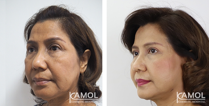 Face Lift 49 lg 6494958f84bc6 image