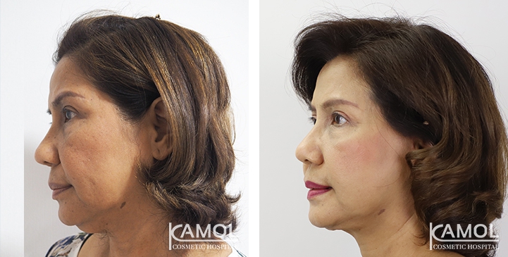 Face Lift 48 lg 6494958f86c4c image