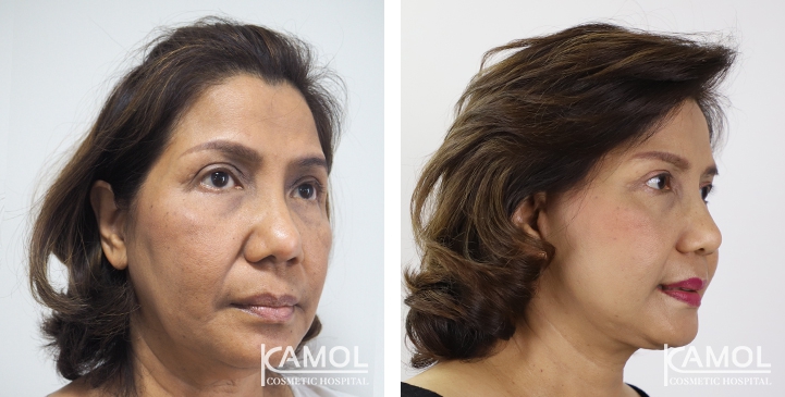 Face Lift 47 lg 6494958f88c06 image