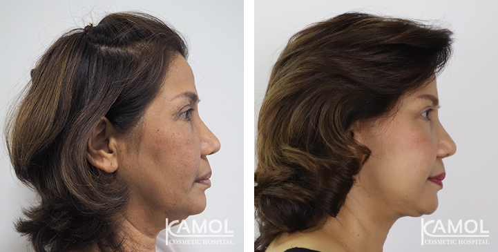 Face Lift 50 lg 6494958f8aaaf image
