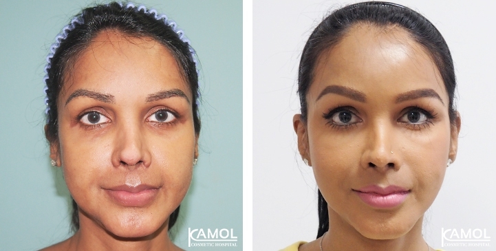 Face Lift 56 lg 6494958f8d631 image