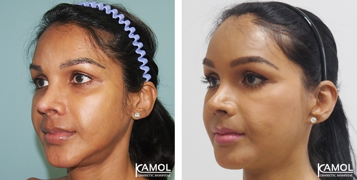 Face Lift 55 lg 6494958f8f517 image