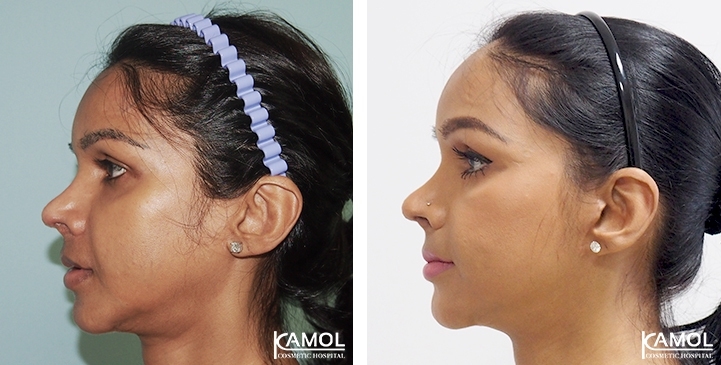 Face Lift 54 lg 6494958f91472 image