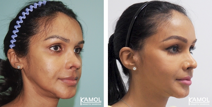 Face Lift 53 lg 6494958f9342f image