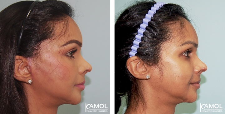 Face Lift 52 lg 6494958f95476 image
