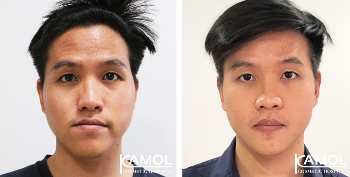 Corrective Jaw Surgery 8 lg 6494958fdb491 image