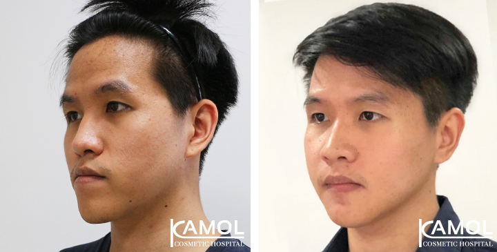 Corrective Jaw Surgery 12 lg 6494958fdd2d6 image