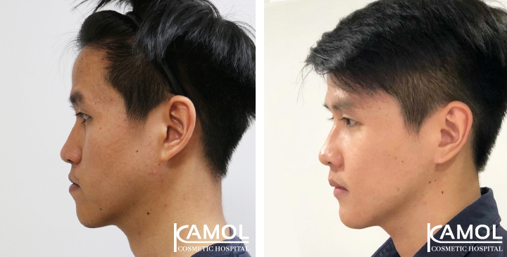 Corrective Jaw Surgery 11 lg 6494958fdf2cc image