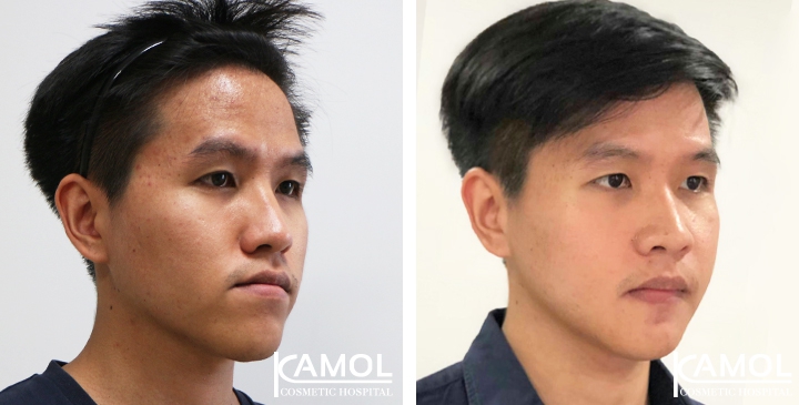 Corrective Jaw Surgery 9 lg 6494958fe102f image