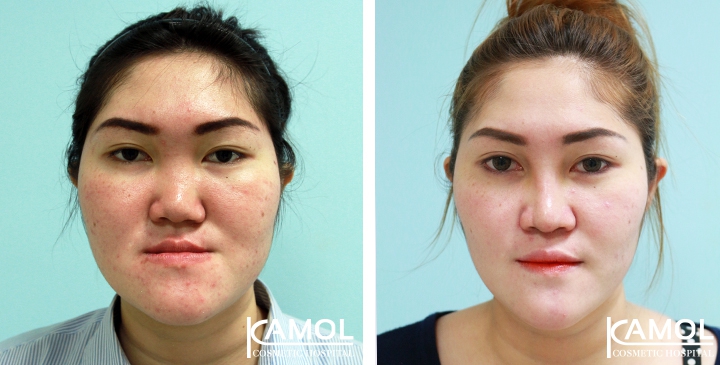 Corrective Jaw Surgery 14 lg 6494958fe5d86 image