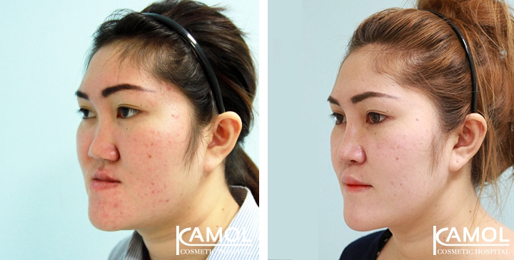 Corrective Jaw Surgery 18 lg 6494958fe7eb1 image
