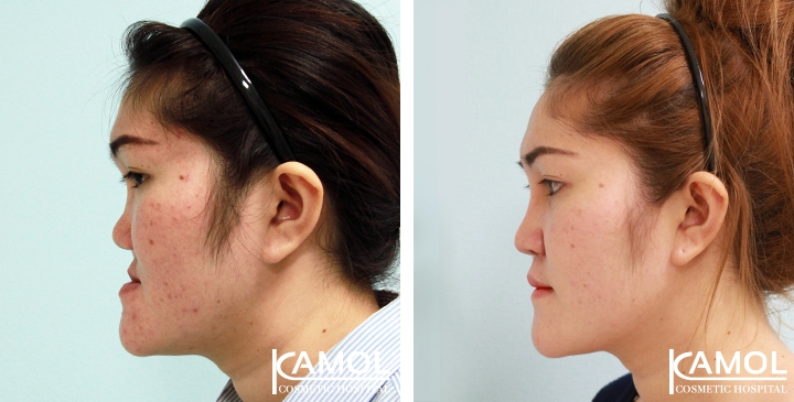 Corrective Jaw Surgery 17 lg 6494958fe9f19 image