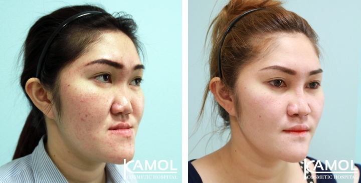 Corrective Jaw Surgery 16 lg 6494958febed1 image