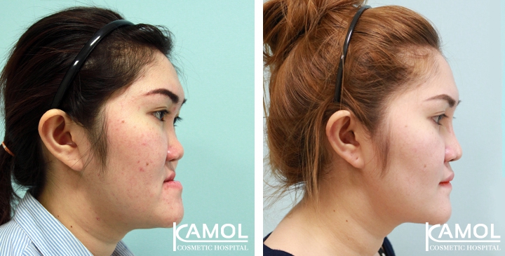 Corrective Jaw Surgery 15 lg 6494958fee194 image